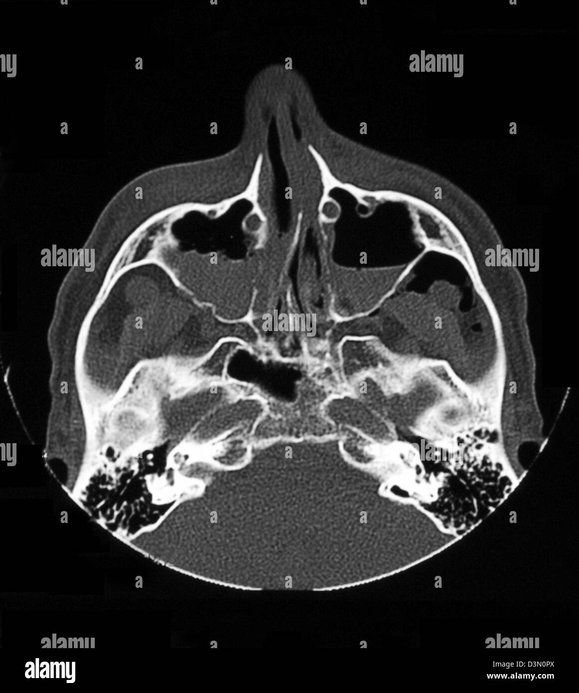 CT scan image mostra bilaterali in seno mascellare fratture Foto Stock