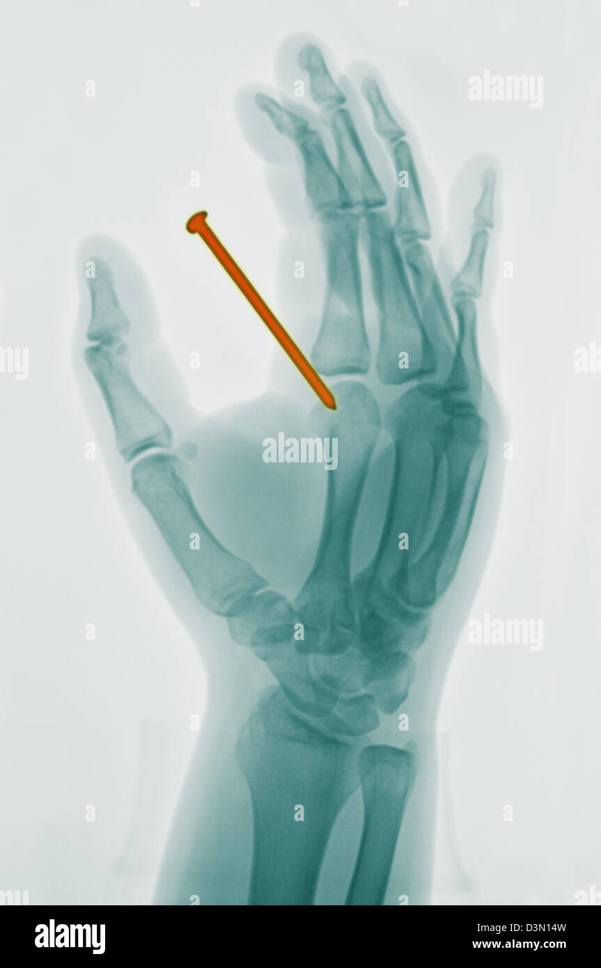 Mano x-ray di 26 anno vecchio che accidentalmente sparato un chiodo da una pistola sparachiodi attraverso la sua mano Foto Stock