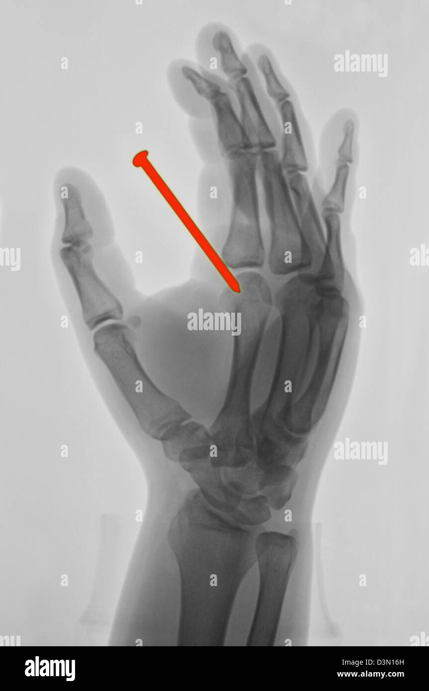 Mano x-ray di 26 anno vecchio che accidentalmente sparato un chiodo da una pistola sparachiodi attraverso la sua mano Foto Stock
