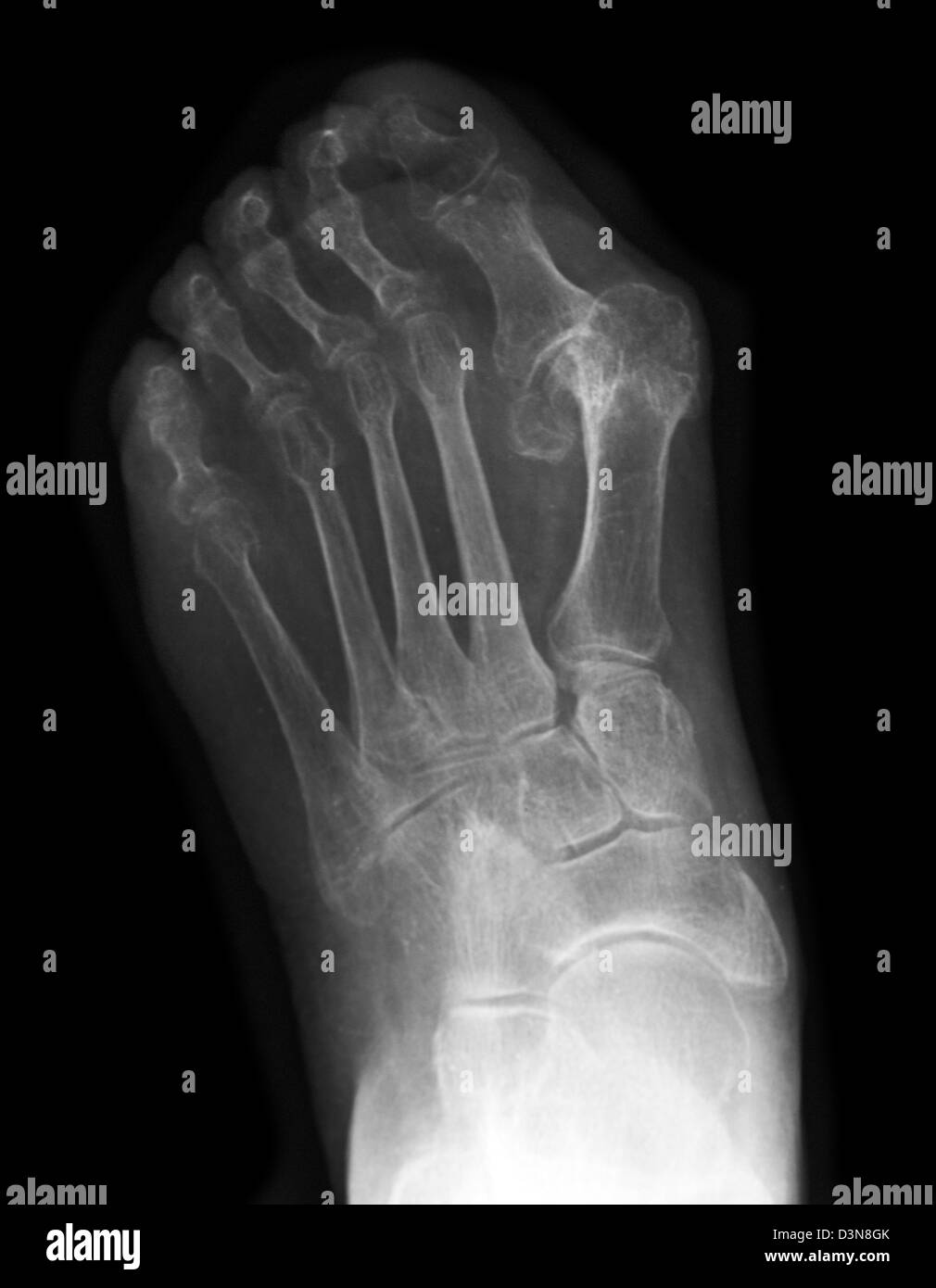 X-ray del piede di un 83 anno vecchia donna che mostra una grave deformità bunion Foto Stock