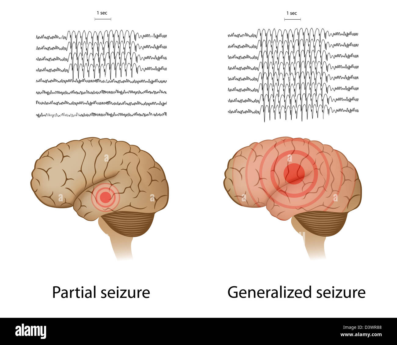EEG in parziale e epilessia generalizzata Foto Stock