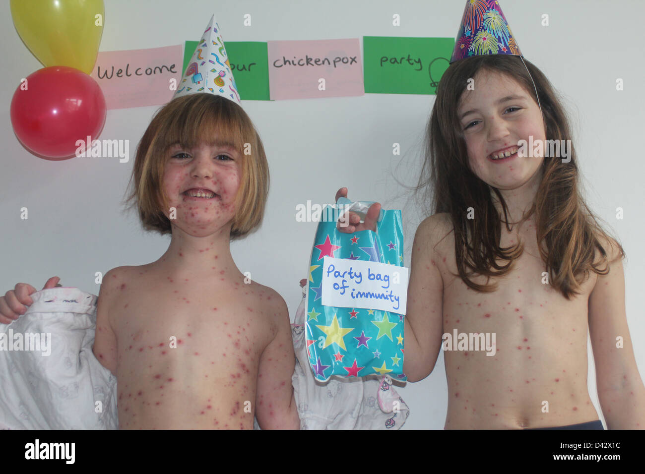 Due ragazze avente una parte di varicella Foto Stock