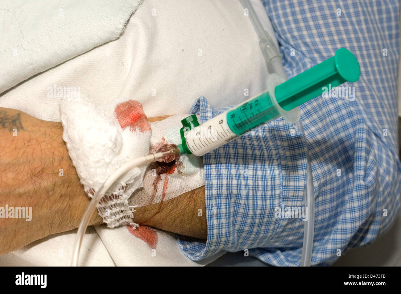 In prossimità di una siringa attaccata alla cannula nel braccio di un paziente. Foto Stock