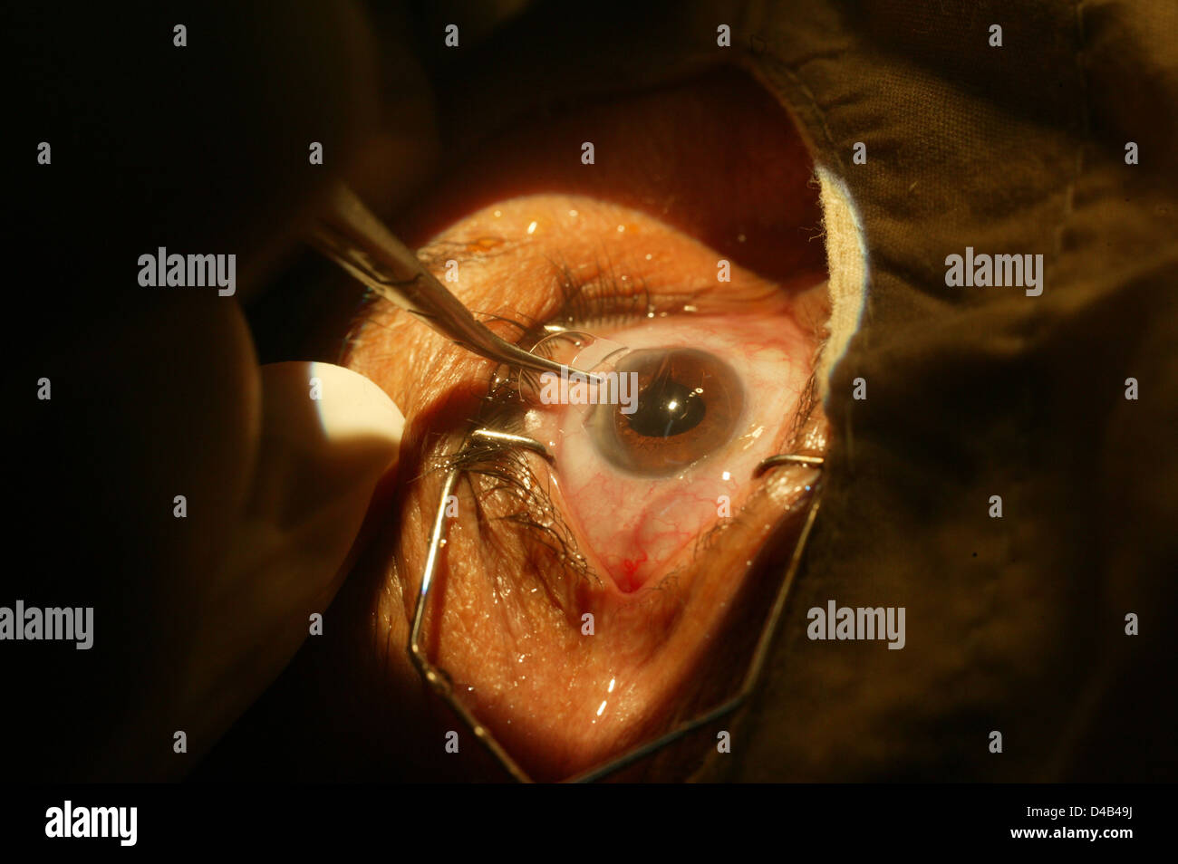 Un chirurgo utilizza gli strumenti chirurgici per rimuovere la lente da un occhio di un paziente con una cataratta Foto Stock