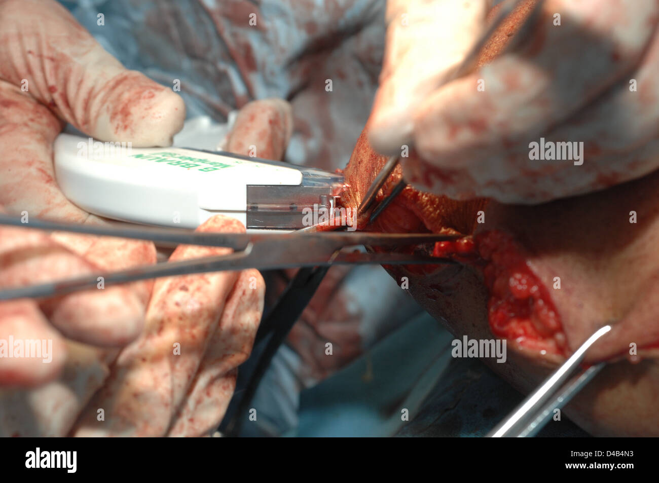 Surgical staples immagini e fotografie stock ad alta risoluzione - Alamy