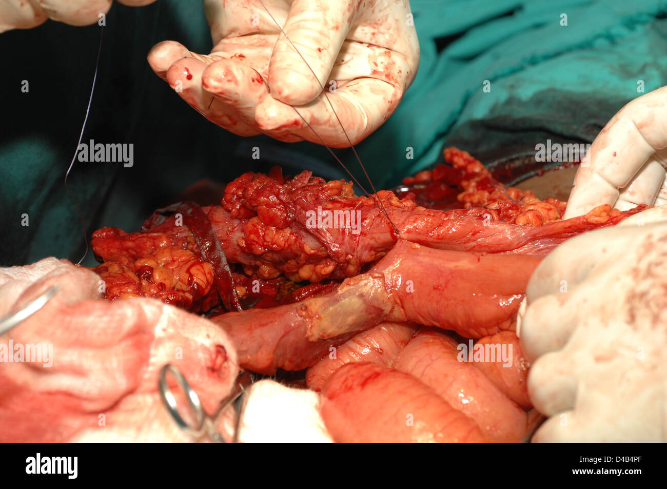 Adesione fibroso del colon. Close-up Foto Stock