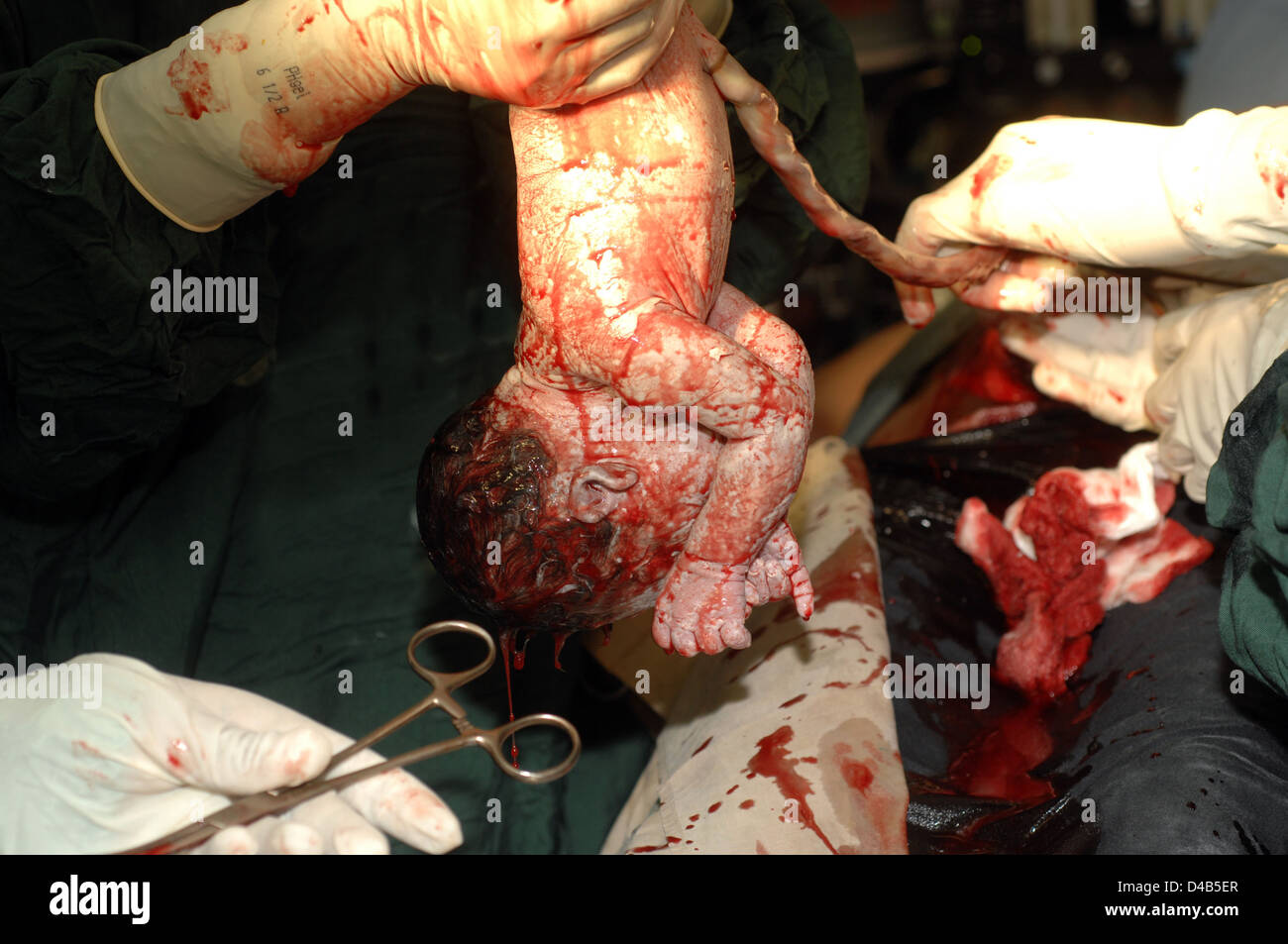 Il neonato tenuta capovolta consentono di scaricare il liquido nei polmoni polmoni essere necessario assumere il cordone ombelicale ha il compito lo scambio di ossigeno anidride Foto Stock