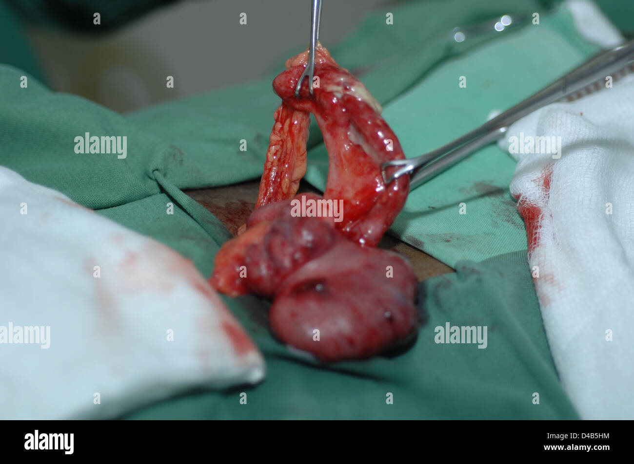Il chirurgo esamina mesoappendix valutare alimentazione sanguigna appendice. Arterie sarà ligato prima appendice distacco Foto Stock
