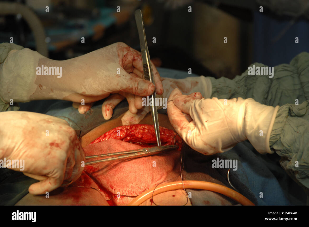 I chirurghi cucitura chiusa paziente ferita addominale dopo la consegna del bambino tramite ceasarean sezione Foto Stock