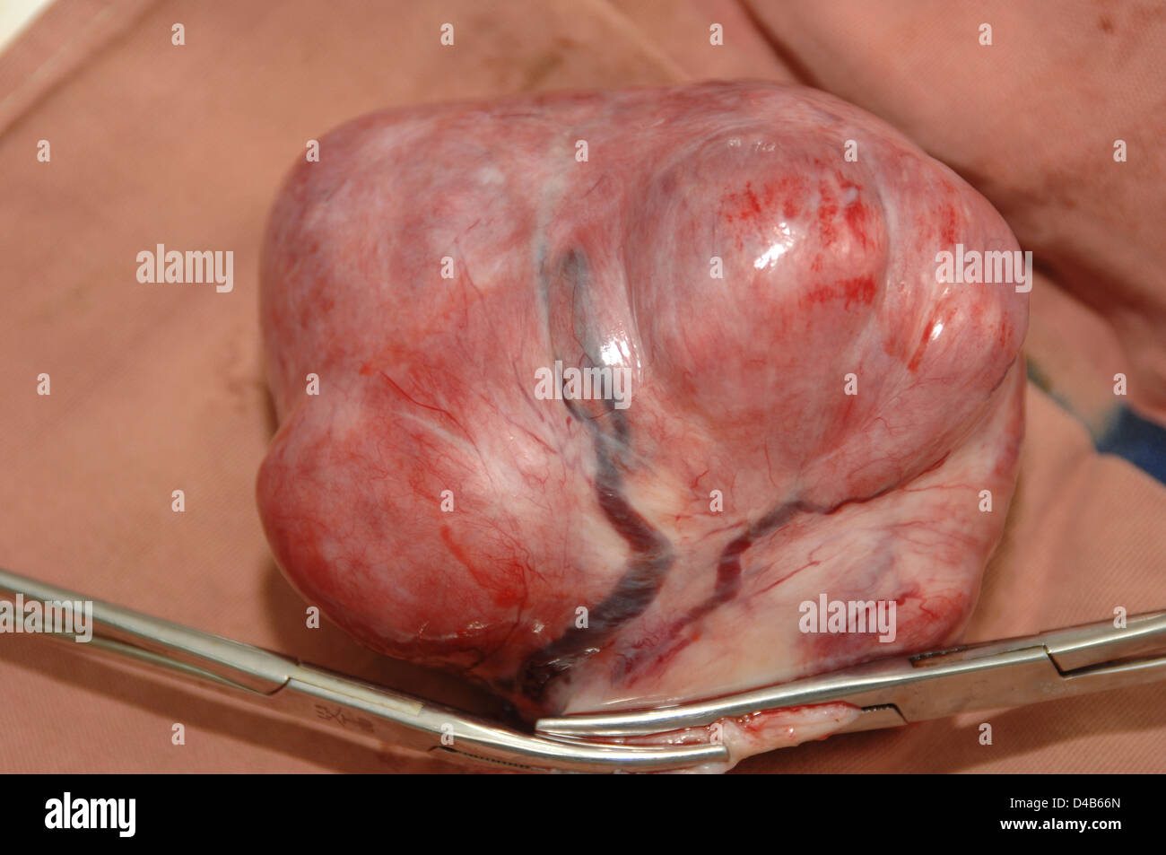 I chirurghi operano per rimuovere i fibroidi uterini Foto Stock