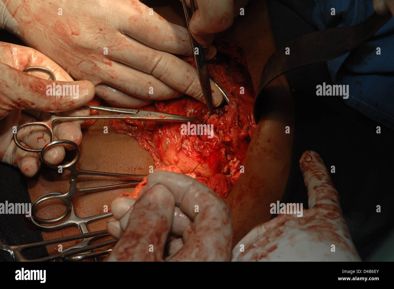 Chirurgo tagliare attraverso l'addome, in modo da rimuovere la milza ingrandita Foto Stock
