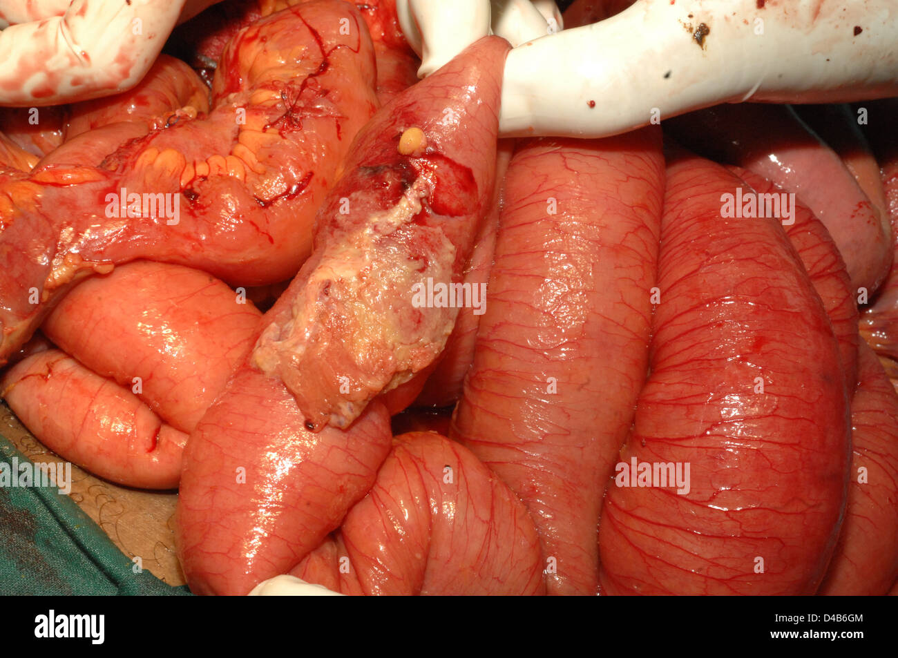 Adesione fibroso del colon Foto Stock