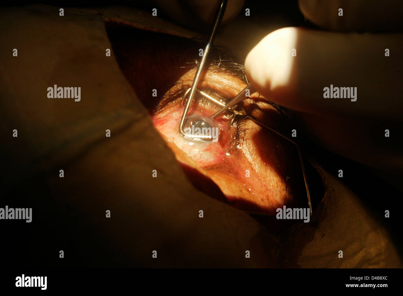 Close up chirurgia della cataratta oculista utilizza il forcipe sollevare cornea mantenerlo retratto mentre cucchiaio di lente impiegato forza nucleo di lente Foto Stock