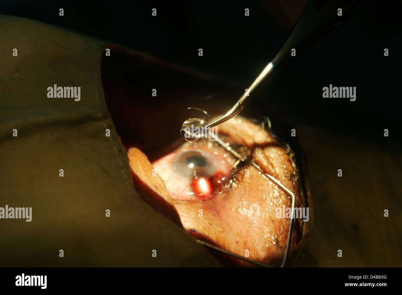I supporti aptici sul lato, fornire una maniglia se la lente deve essere regolata nella ferita. Foto Stock