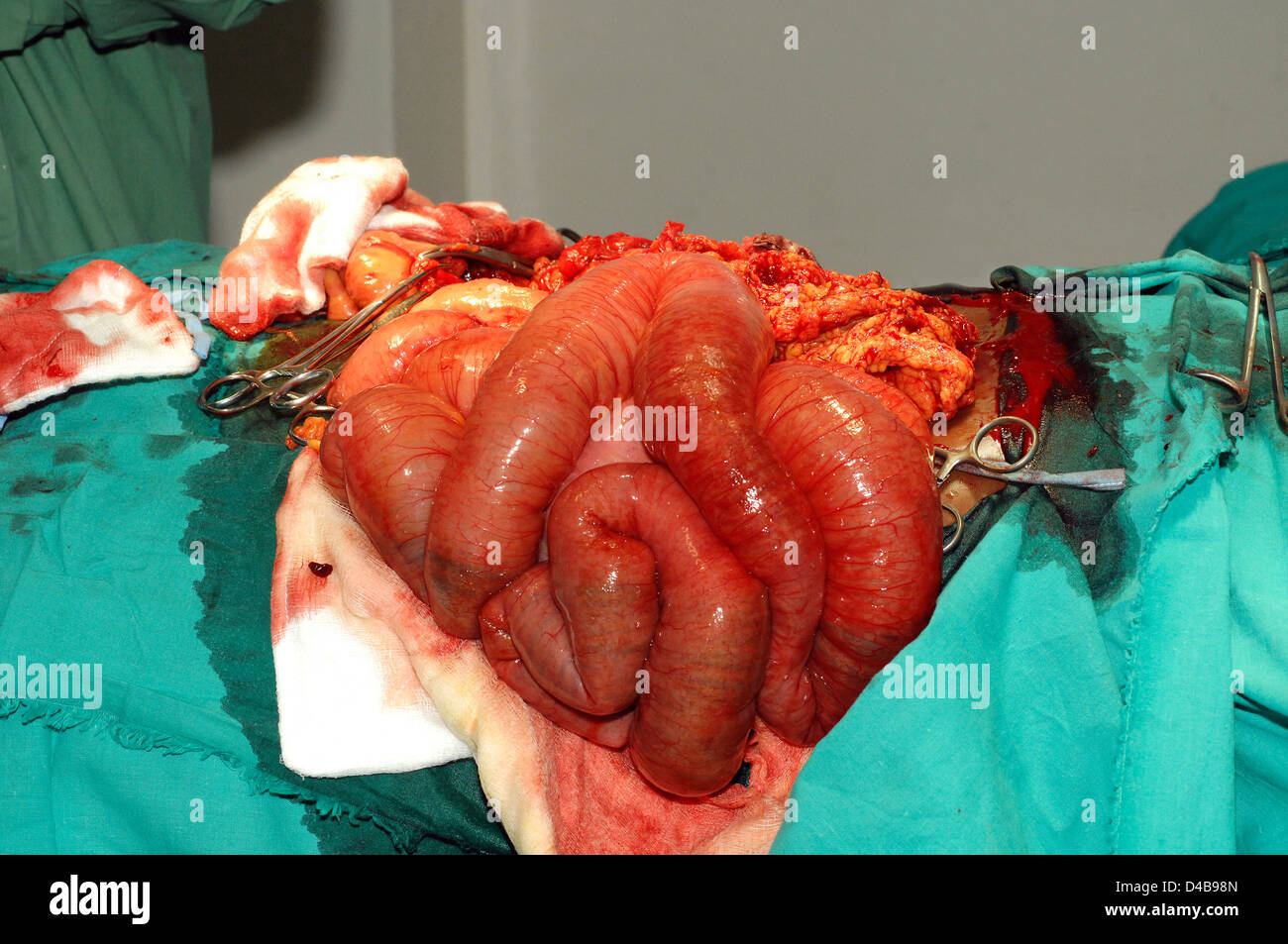 Close-up di adesione fibroso del colon. Foto Stock