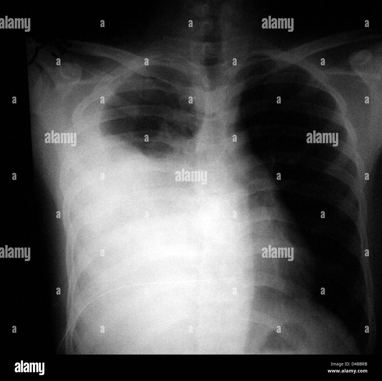 Questo potrebbe ostacolare la capacità del paziente di espandere i polmoni e respirare, come vi è un limitato spazio all'interno della cavità toracica. Foto Stock