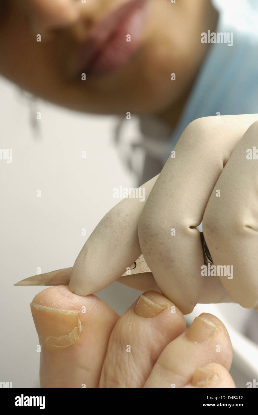 Podiatrist usando un bisturi per rimuovere indurito e calloused pelle dal piede del paziente Foto Stock