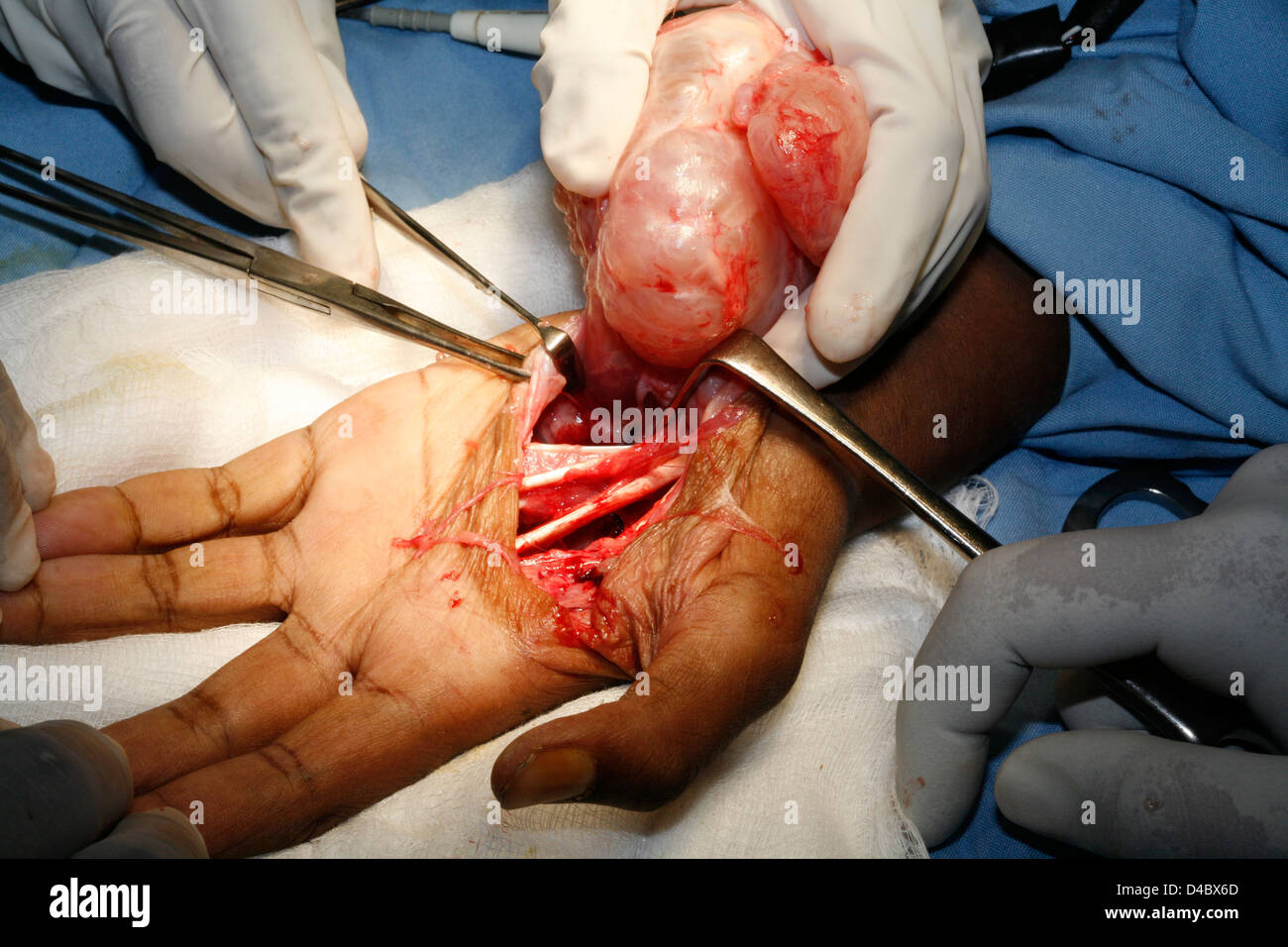 I chirurghi del taglio del tessuto connettivo da neurofibroma del tumore. Foto Stock