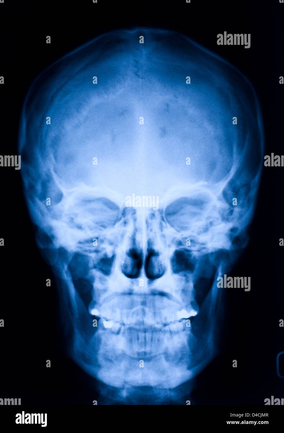 Immagine del cranio xray blu Foto Stock