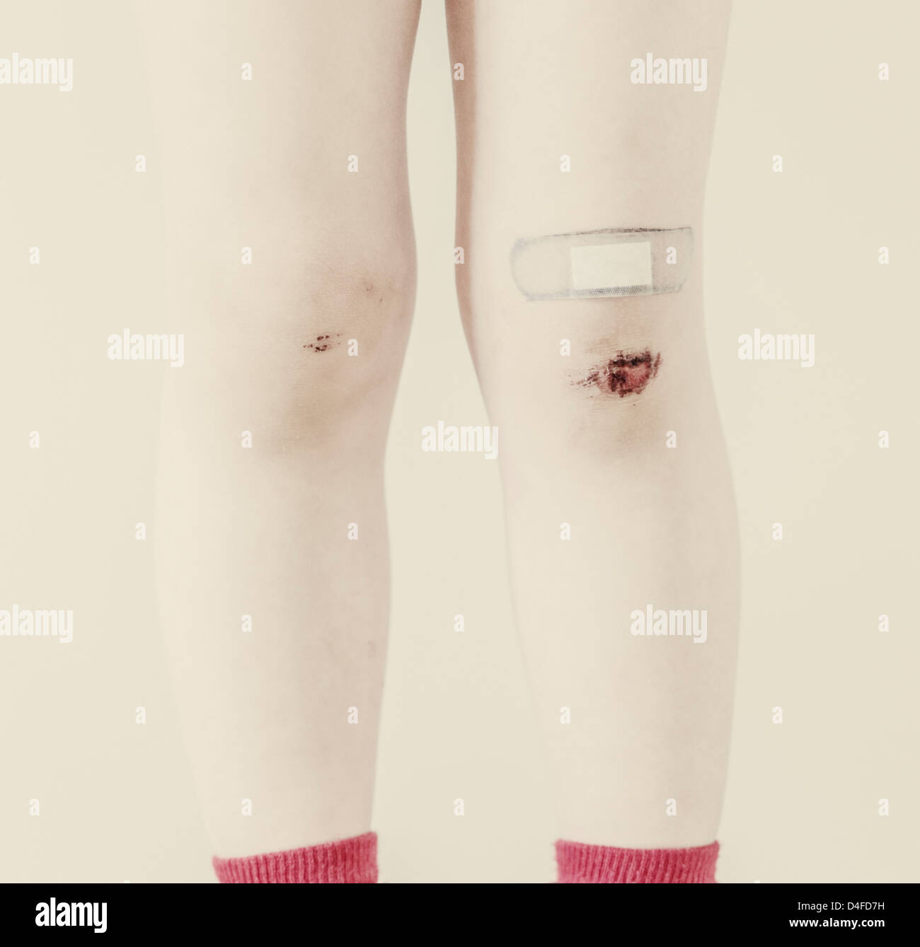 Primo piano delle gambe di un giovane bambino con ammaccature e bandaid Foto Stock