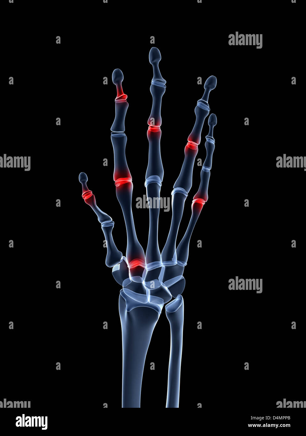 X-ray mano - artrite Foto Stock