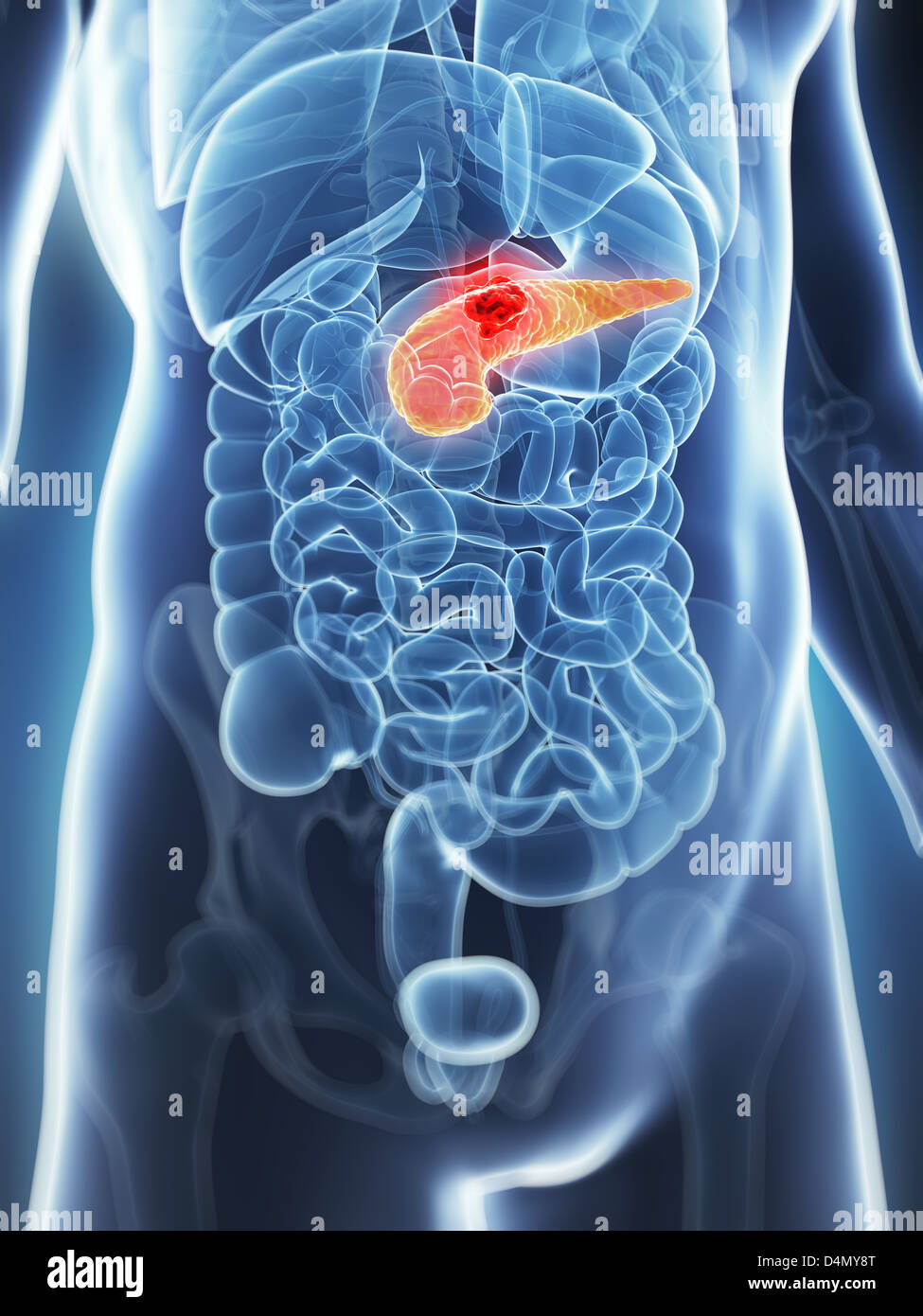 Il pancreas - il cancro Foto Stock