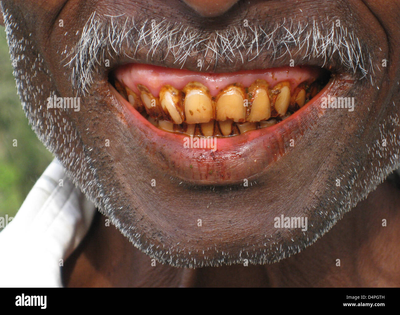 (Dpa) file di un file immagine datata 23 febbraio 2008 visualizza i denti di un uomo avente comsumed noci di betel in Ella, Sri Lanka. Noci di betel sono un tipo molto diffuso di indulgenza del cibo con un effetto stimolante, ancora estremamente dannosi per la mucosa orale e dei denti. Foto: Rolf Haid Foto Stock