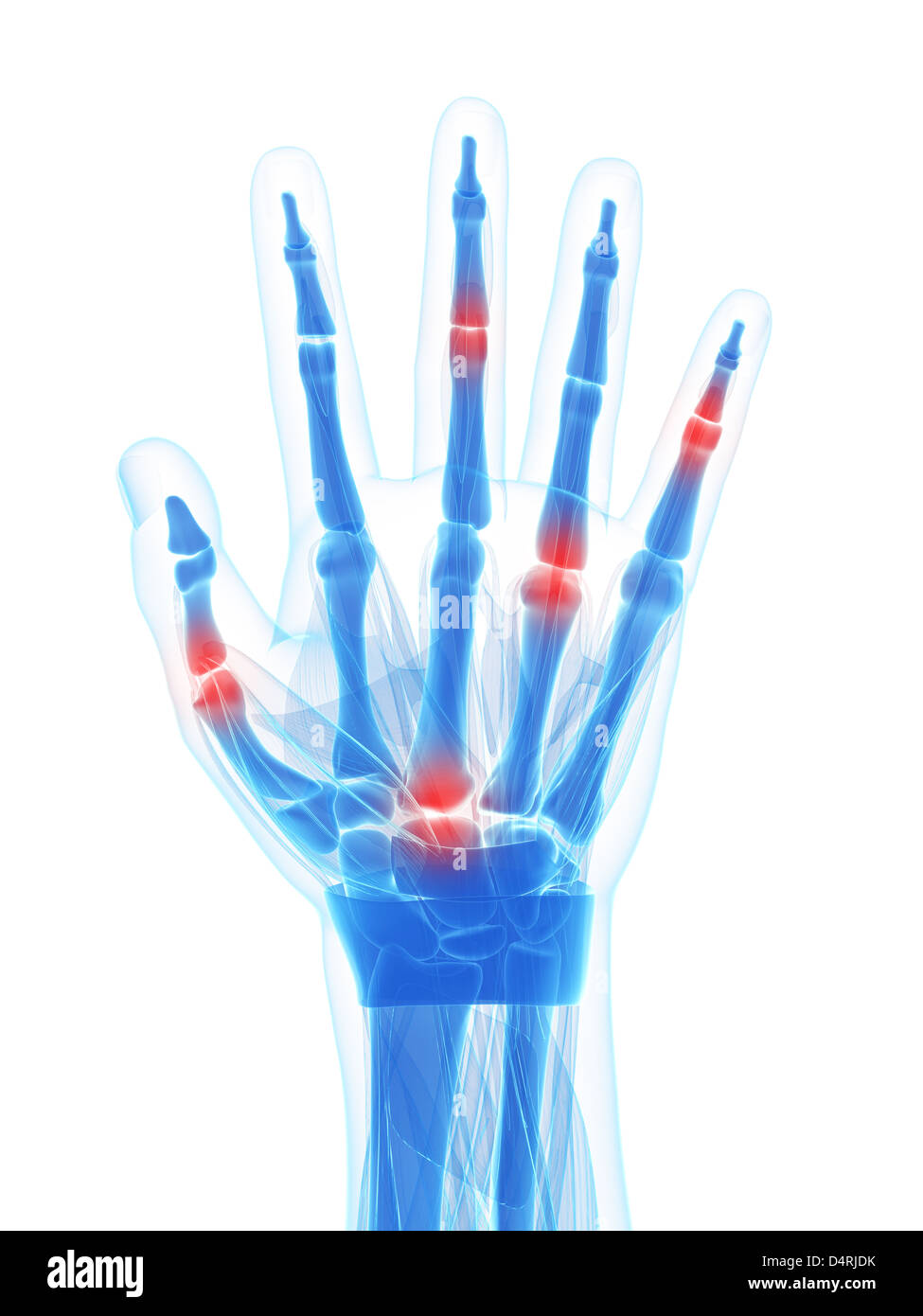 X-ray mano - artrite Foto Stock