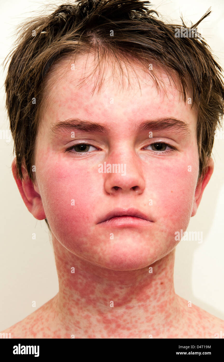 Ragazzo con una eruzione cutanea causata da una reazione allergica Foto Stock