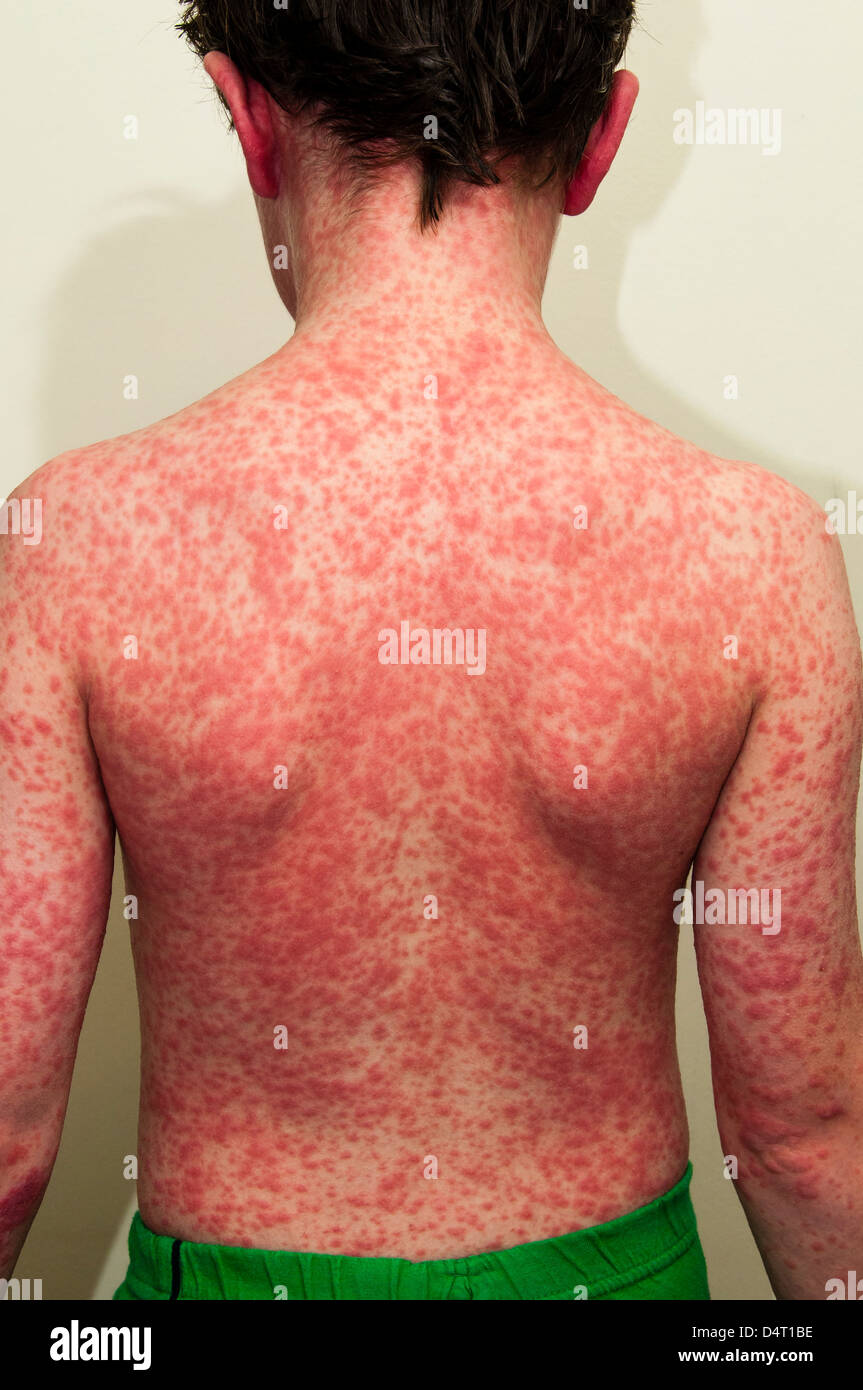 Ragazzo con una eruzione cutanea causata da una reazione allergica Foto Stock