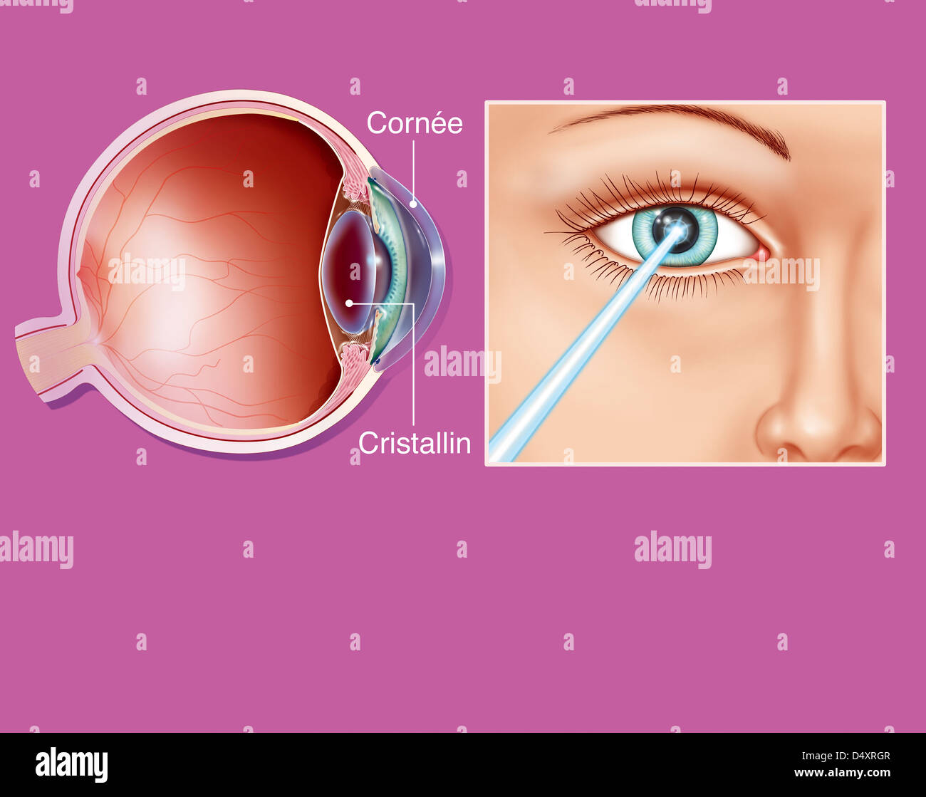 La chirurgia oculare, disegno Foto Stock