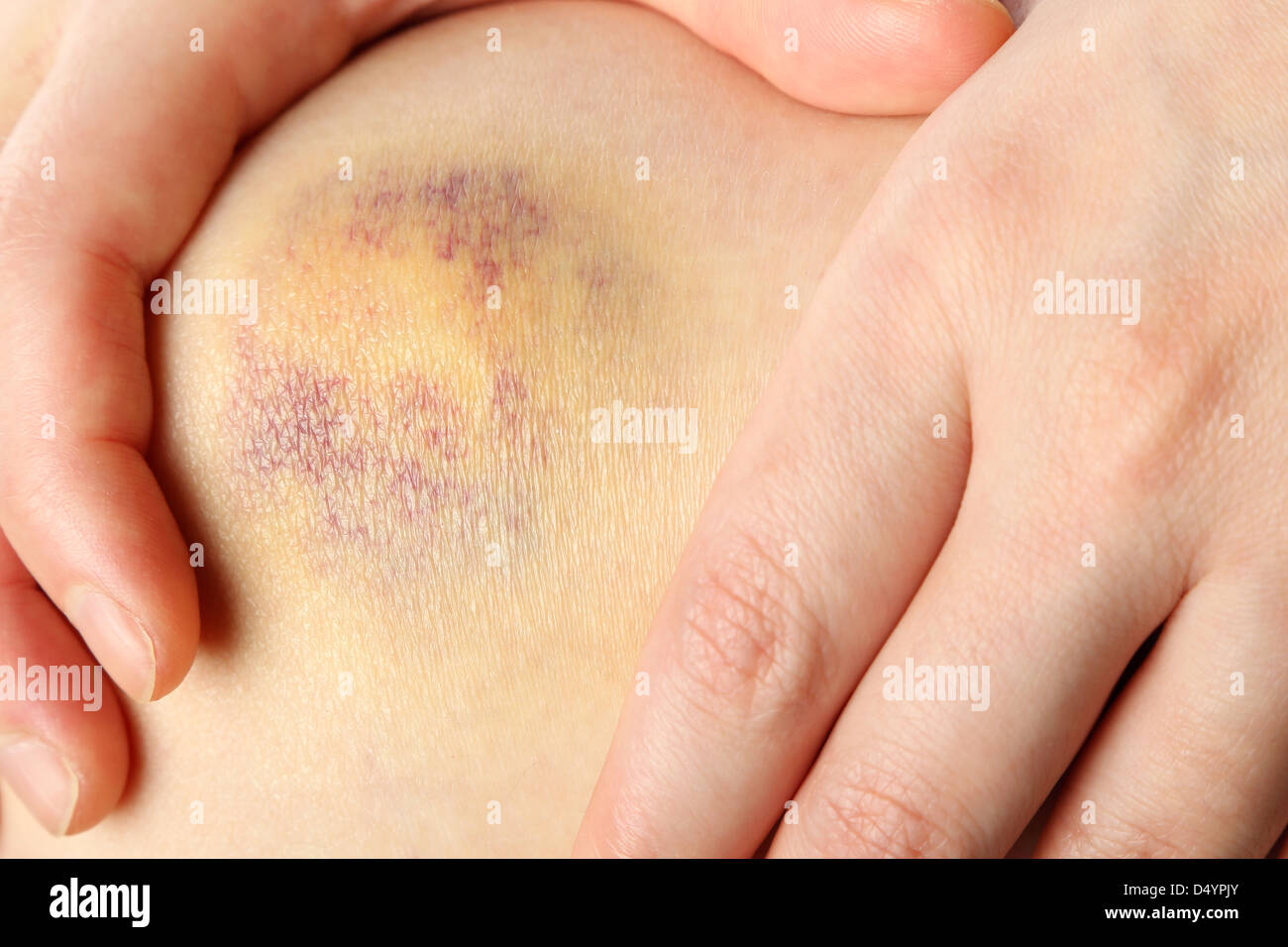 Contusione al ginocchio di una donna Foto Stock