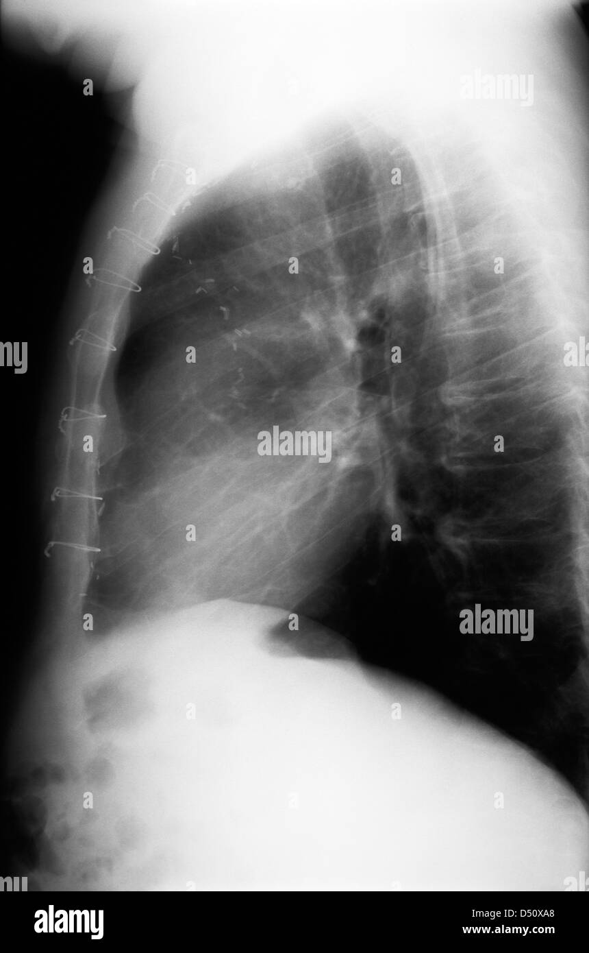 Berlino, Germania, Roentgenaufnahme laterale del torace osseo di un uomo Foto Stock