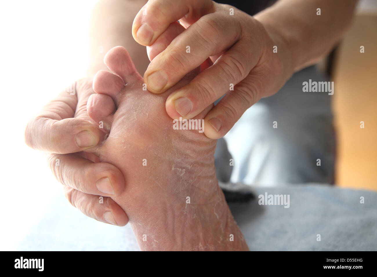 Un uomo con la pelle secca sul suo piede e tra le sue dita dei piedi Foto Stock