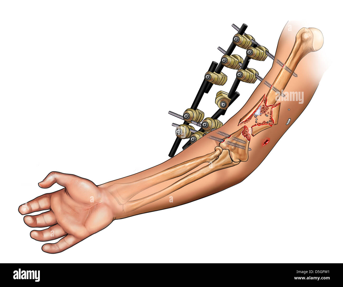 Fissatore esterno applicato a Omero Foto stock - Alamy