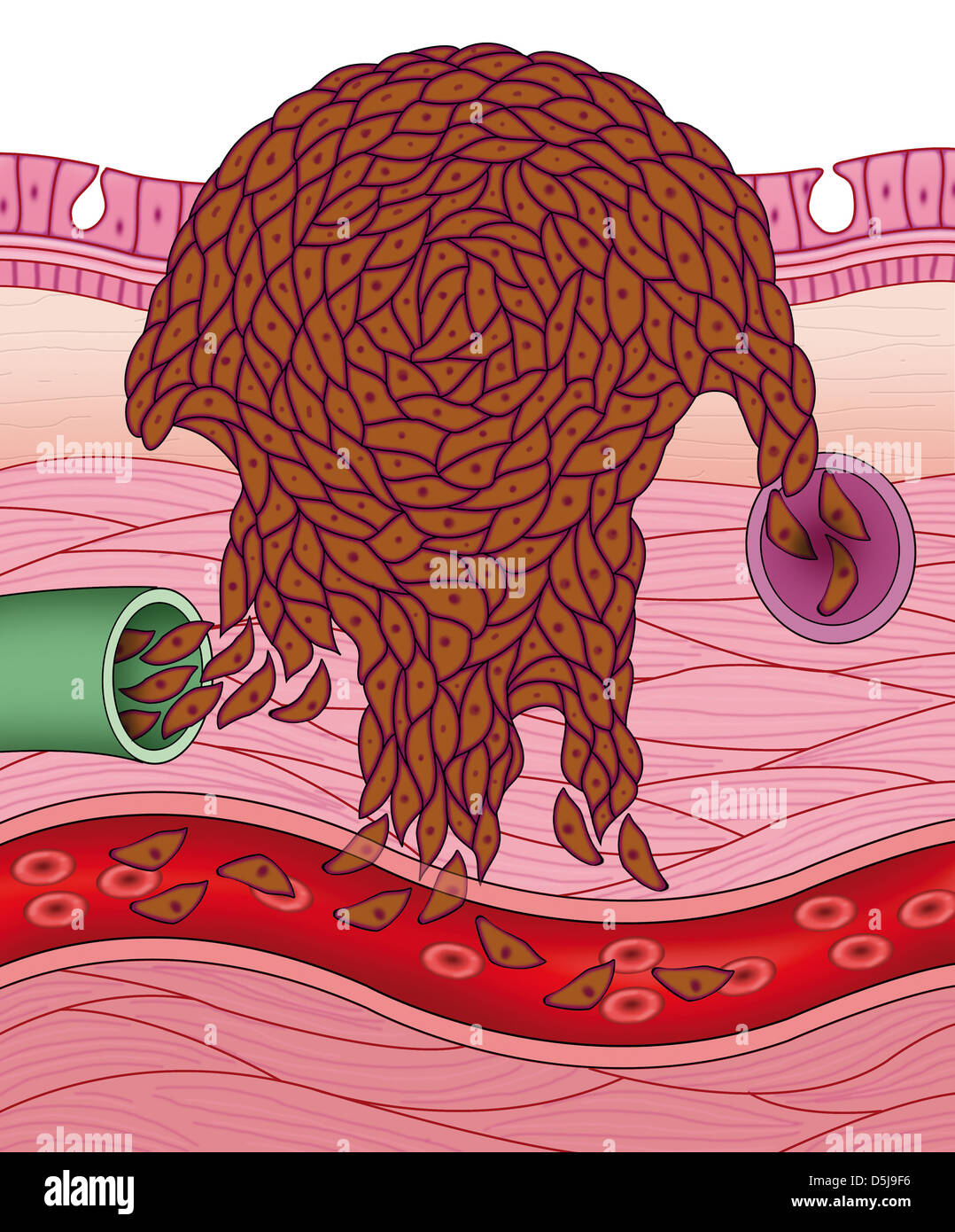 La malattia, dolore, metastasi di cellule, Foto Stock