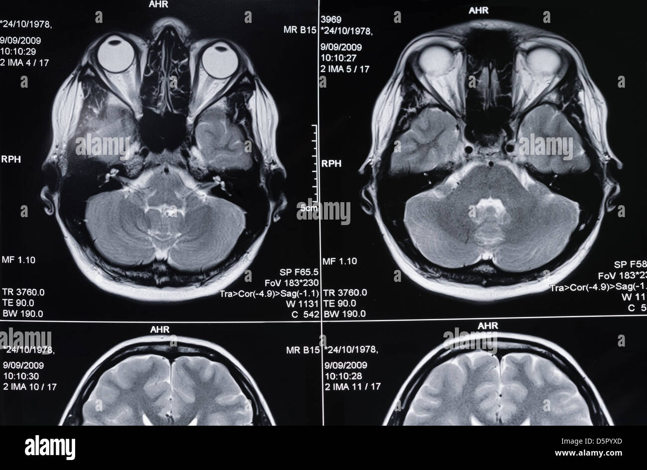 Primo piano di un computer di tomografia assiale di scansione (CAT) di scansione di una testina Foto Stock