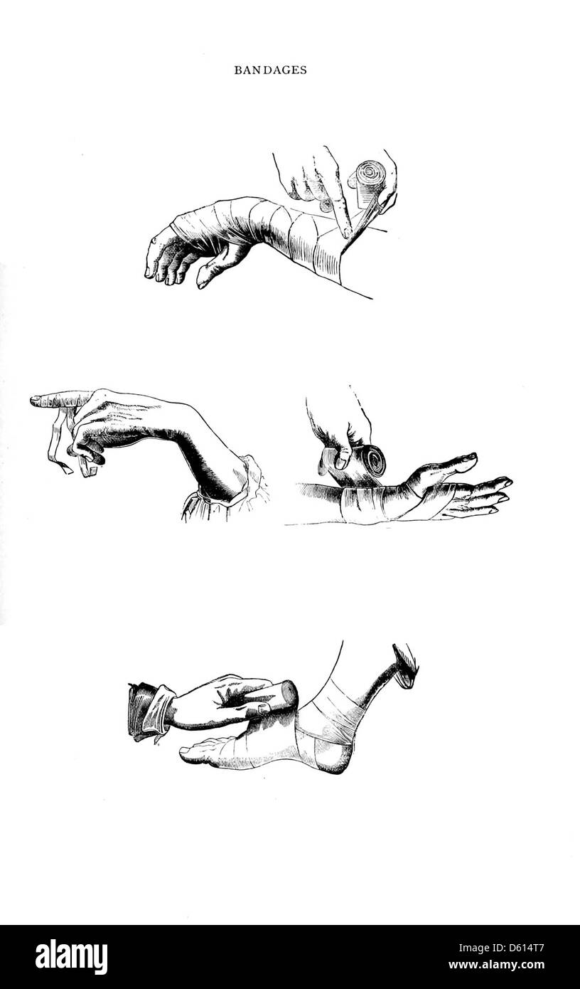 L'edizione 1878 di "A Domestic Cyclopædia of Practical Information" fornisce informazioni utili su varie pratiche domestiche, tra cui l'applicazione di bende per il primo soccorso. La voce descrive i metodi per il trattamento delle lesioni, offrendo consigli pratici per l'assistenza sanitaria domiciliare. Foto Stock