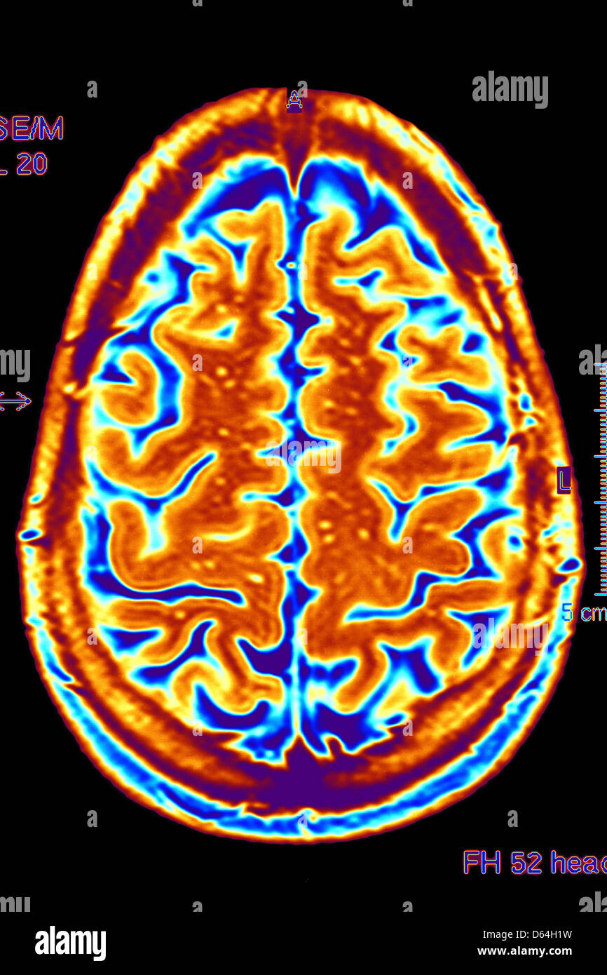 Scansione cerebrale, MRI scan Foto Stock