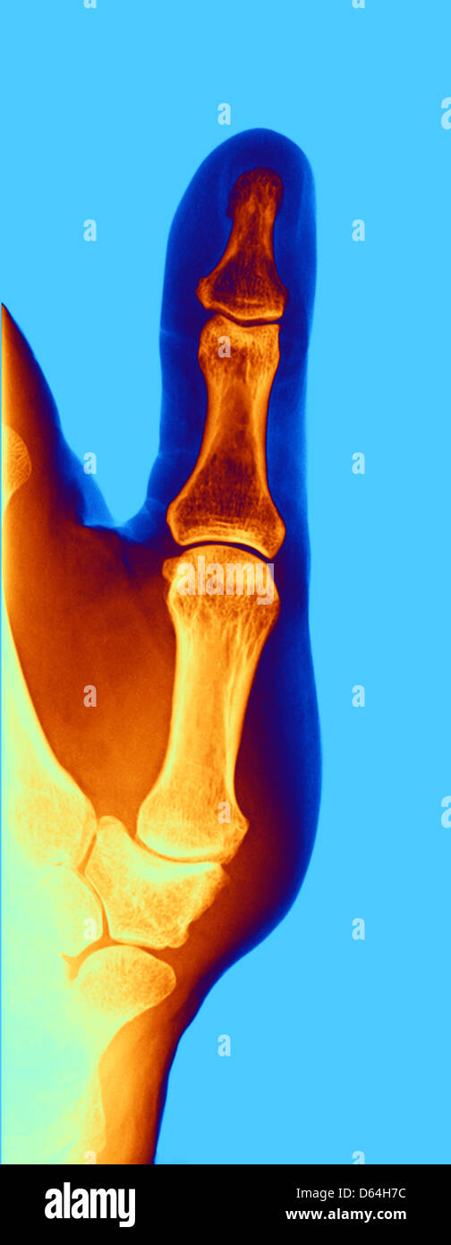 Artrosi della mano, X-ray Foto Stock