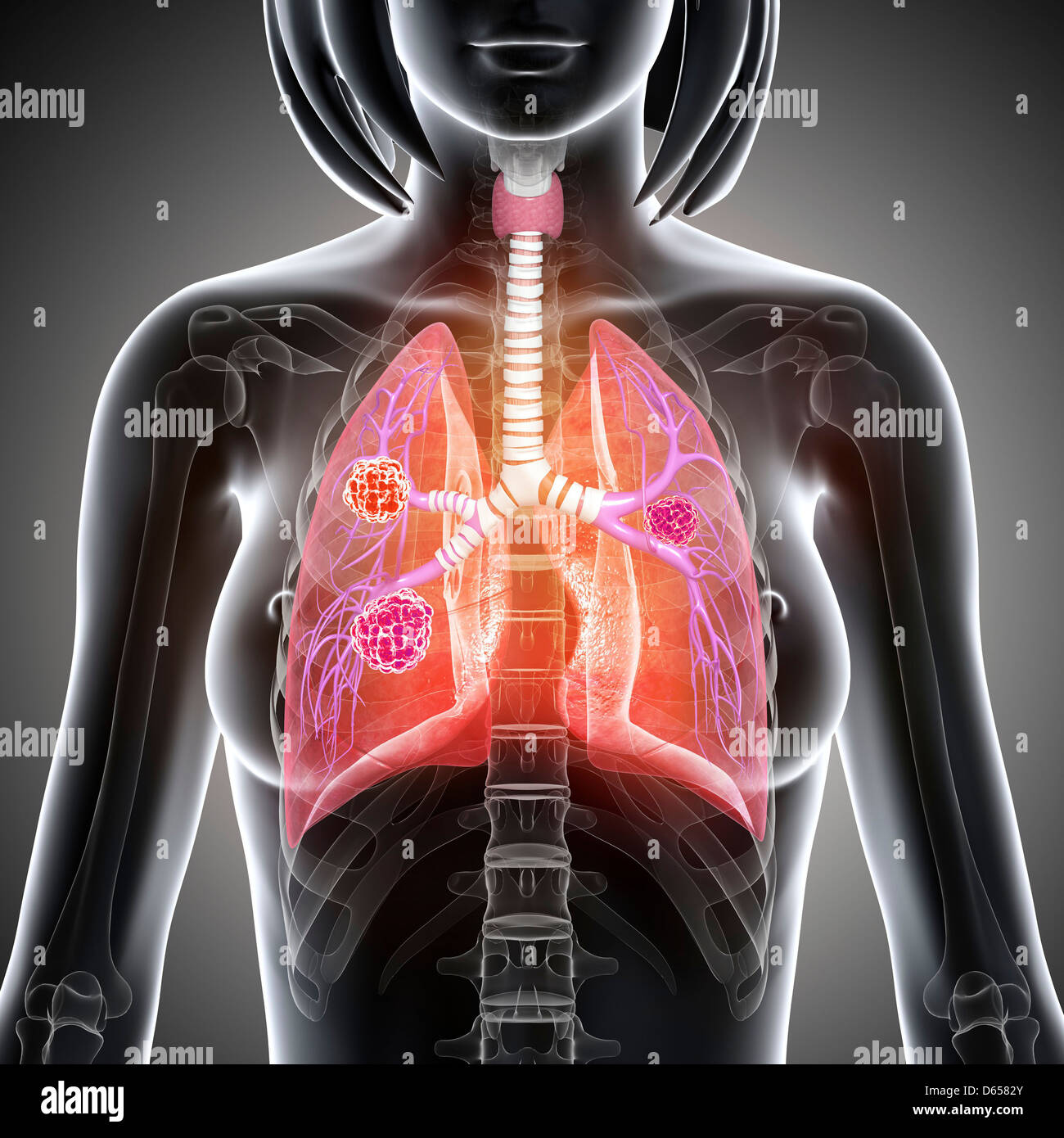 Femmina di cancro ai polmoni, artwork Foto Stock