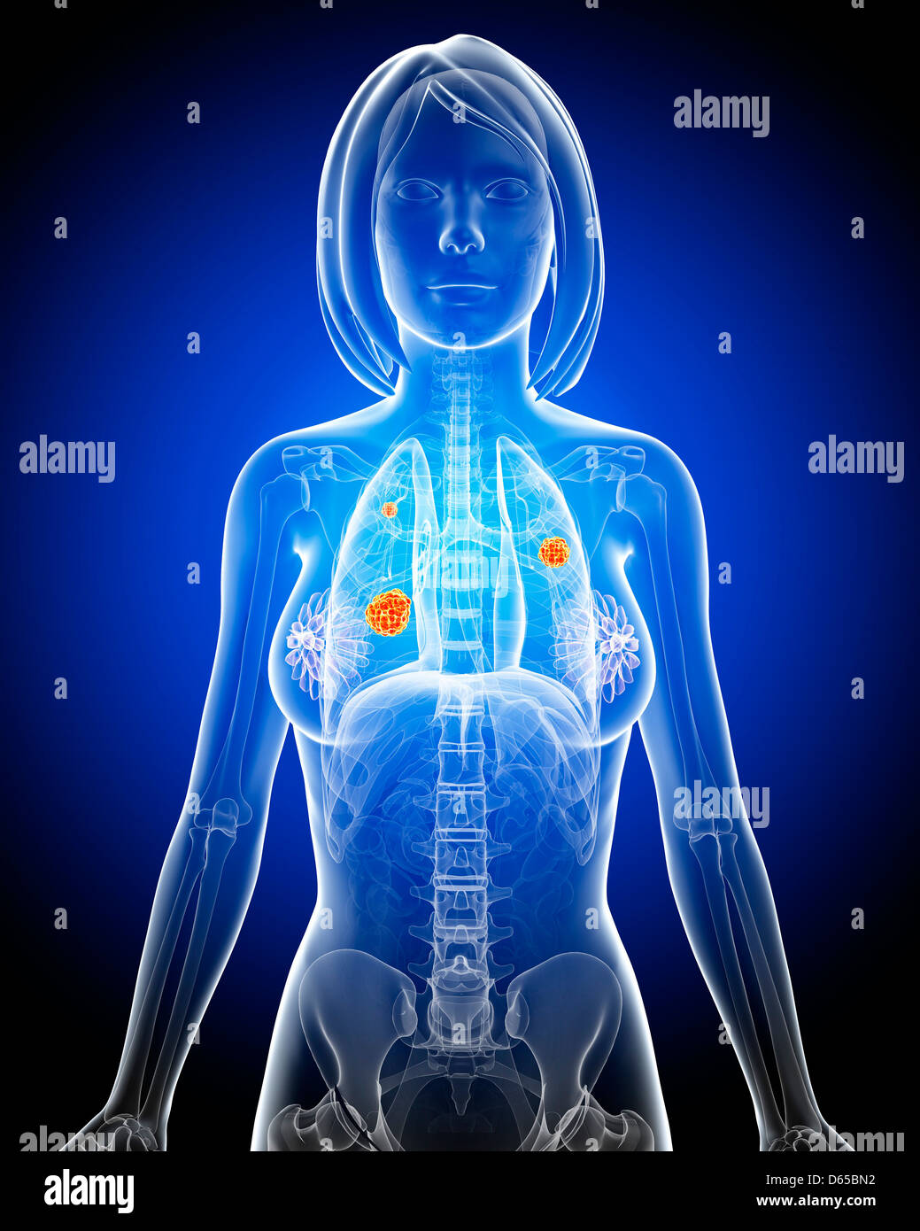 Femmina di cancro ai polmoni, artwork Foto Stock