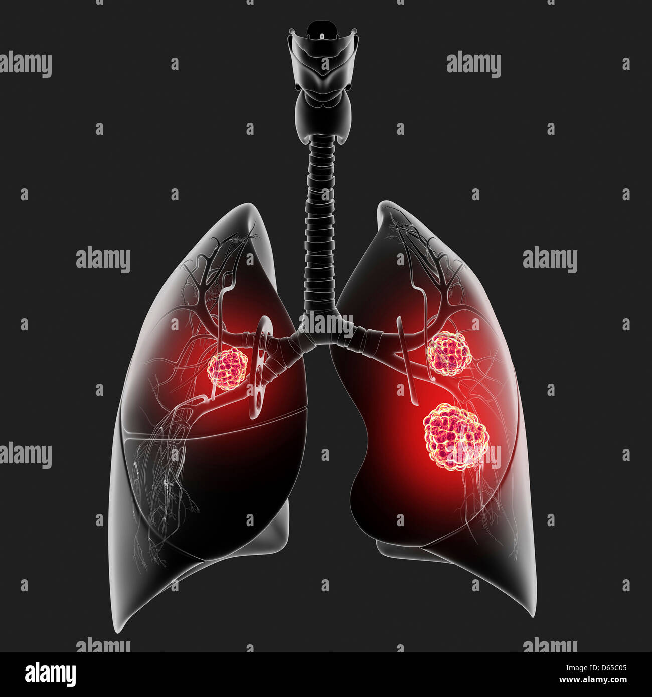 Il cancro del polmone, artwork Foto Stock