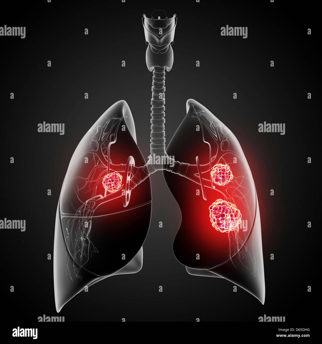 Il cancro del polmone, artwork Foto Stock