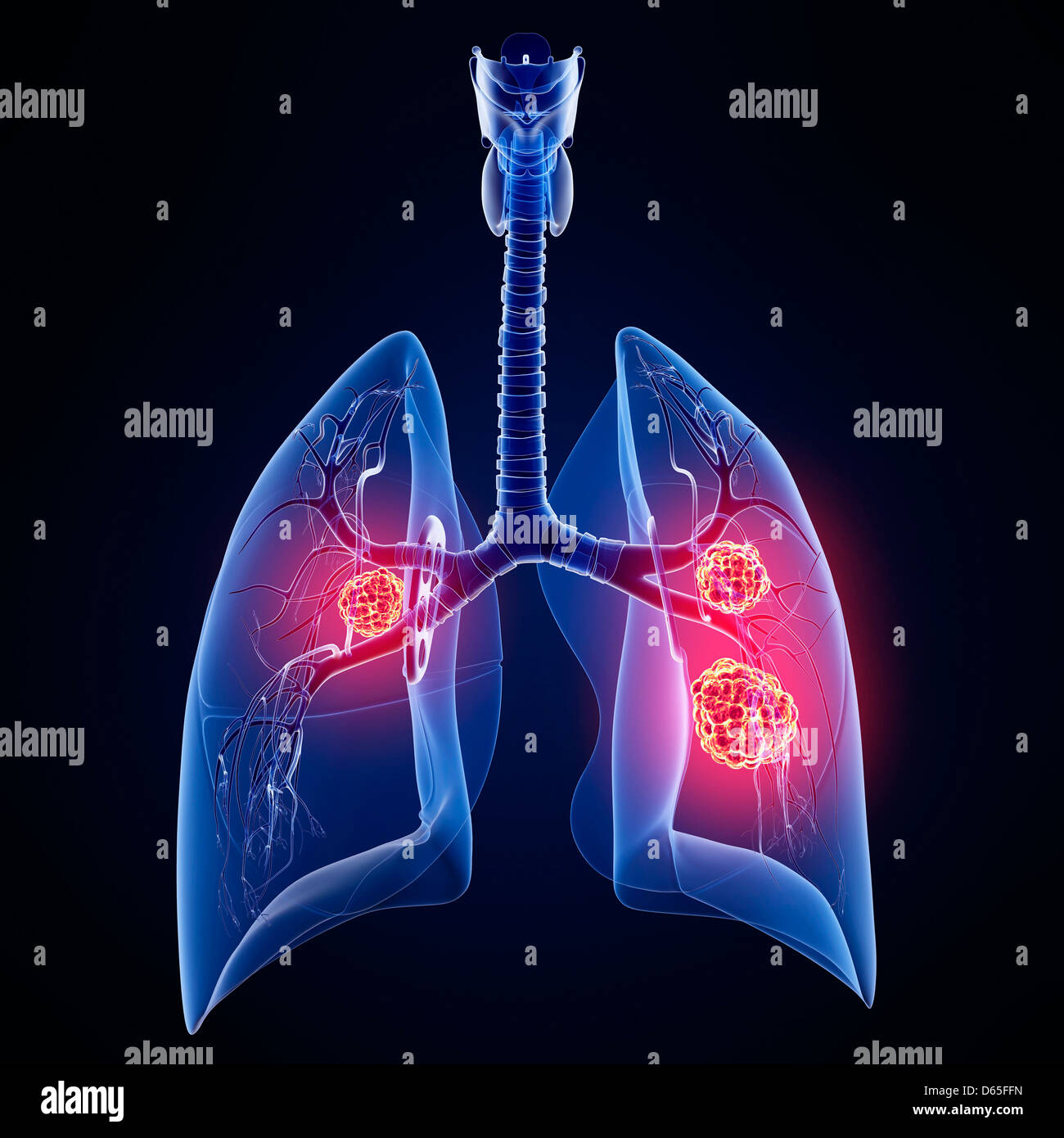 Il cancro del polmone, artwork Foto Stock