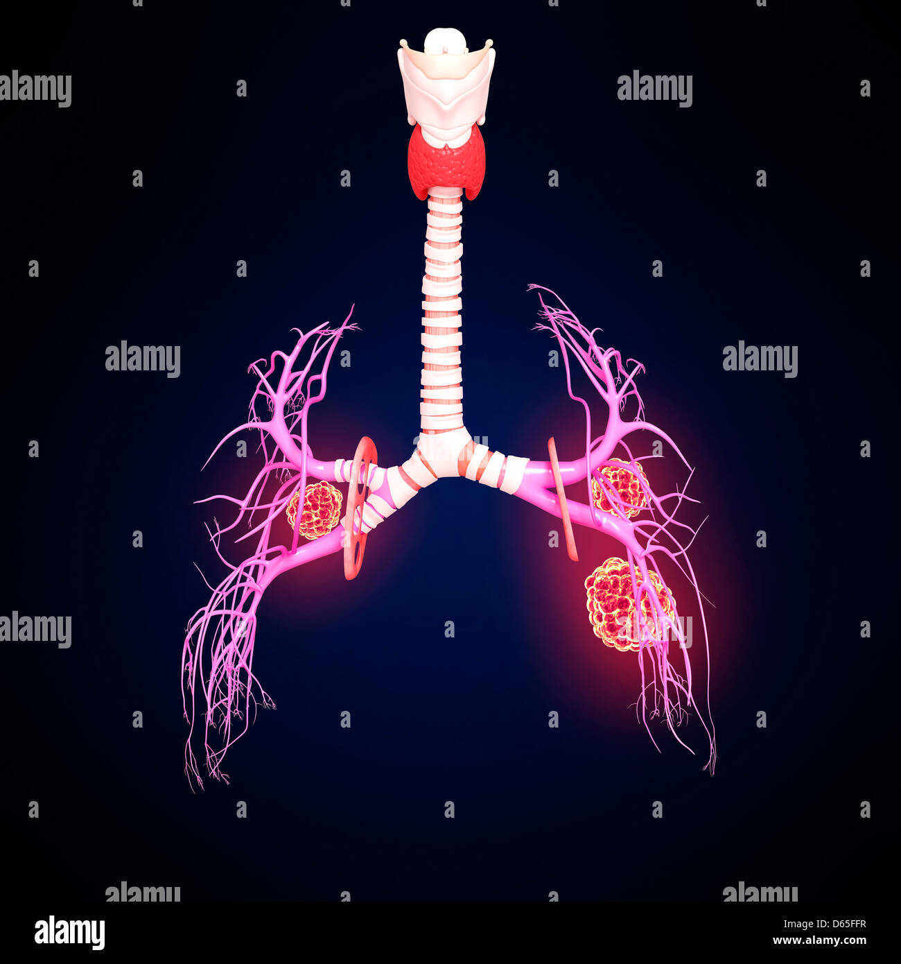 Il cancro del polmone, artwork Foto Stock