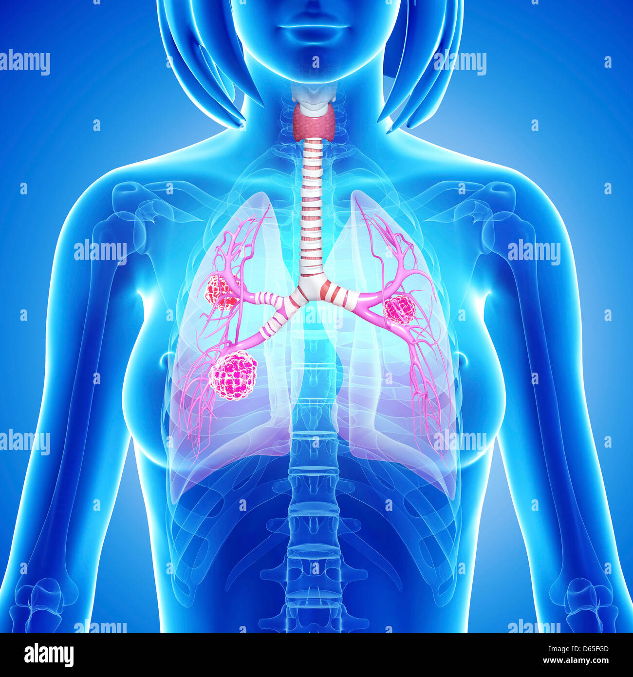 Femmina di cancro ai polmoni, artwork Foto Stock