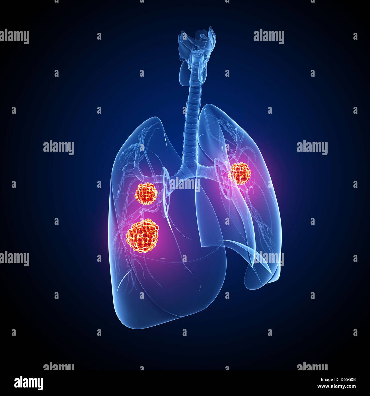 Il cancro del polmone, artwork Foto Stock