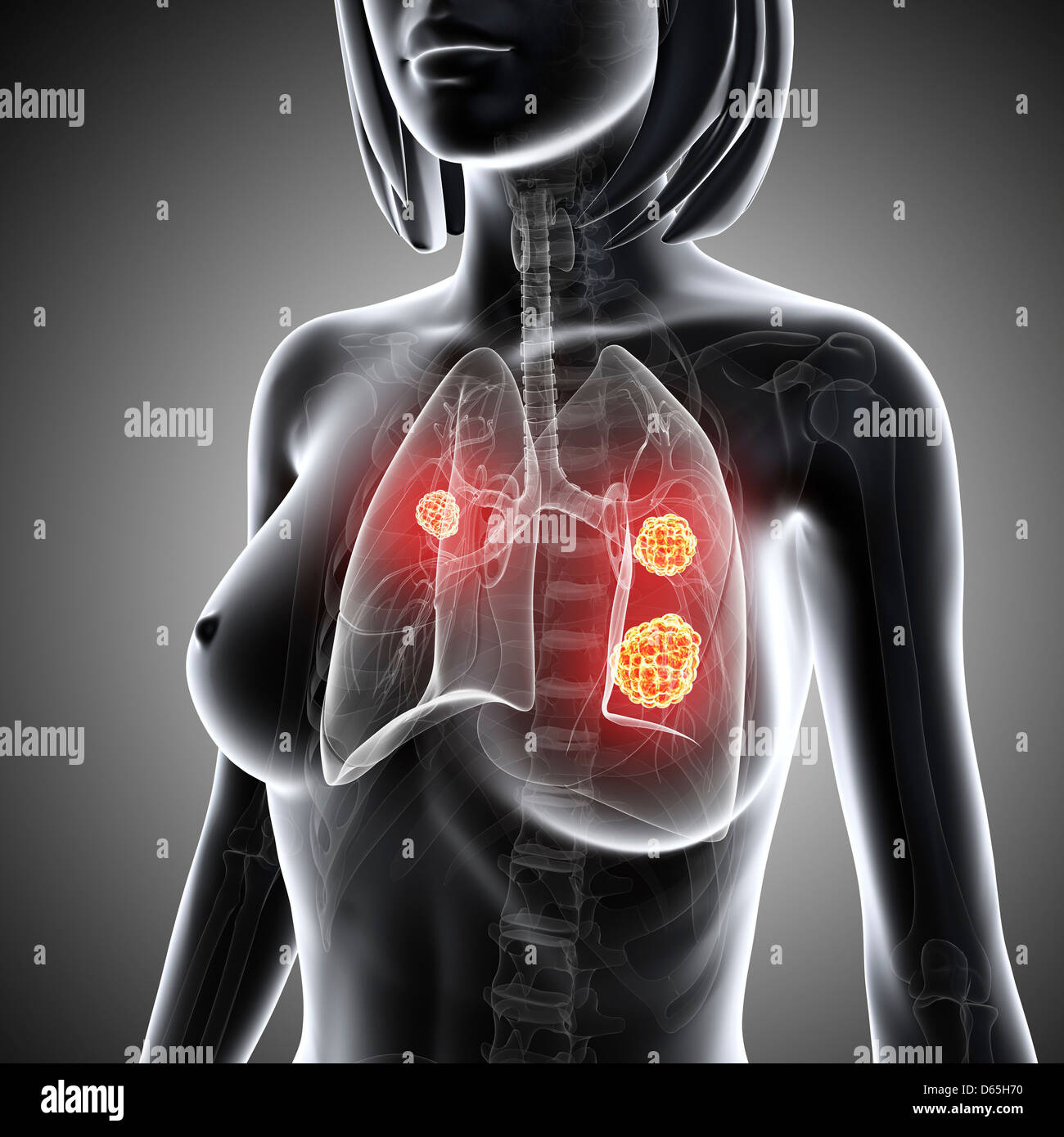 Femmina di cancro ai polmoni, artwork Foto Stock