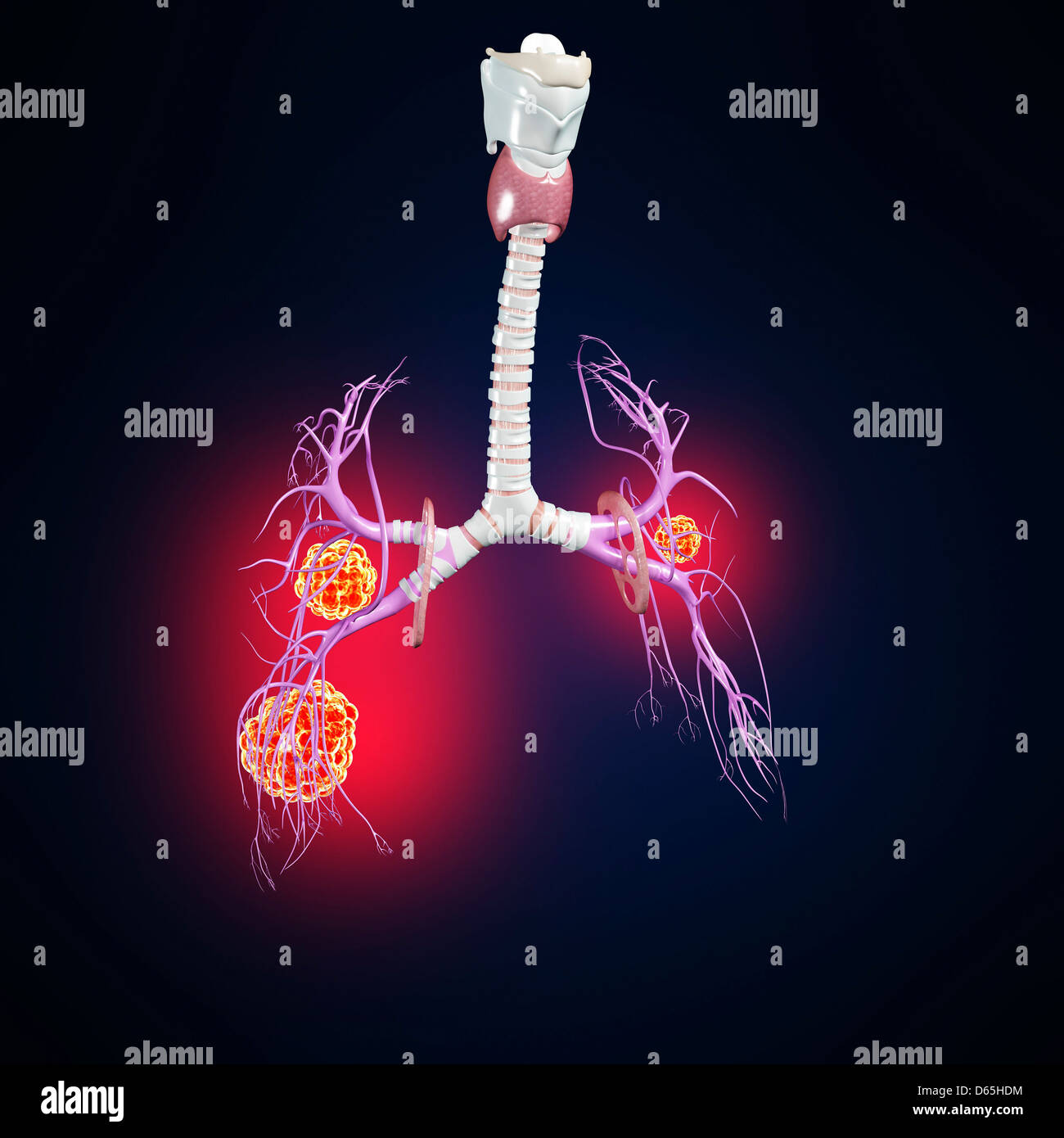 Il cancro del polmone, artwork Foto Stock